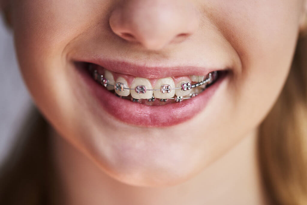 Orthodontics Services Orthodontist Columbus Ohio South High Dental