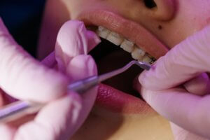 Traditional Braces Being Placed